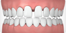 Widely spaced teeth